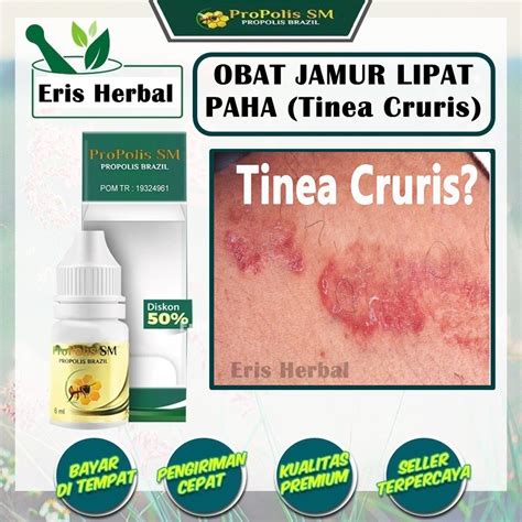 Jamur Tinea Cruris Homecare24