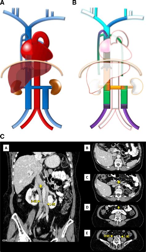 A Double Ivc Schematic With The Left Component Draining To The Left