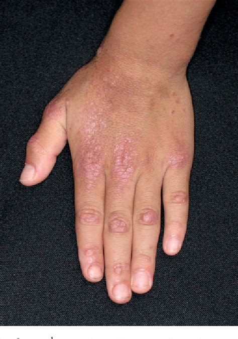 Figure 1 From A Case Of Juvenile Dermatomyositis Manifesting