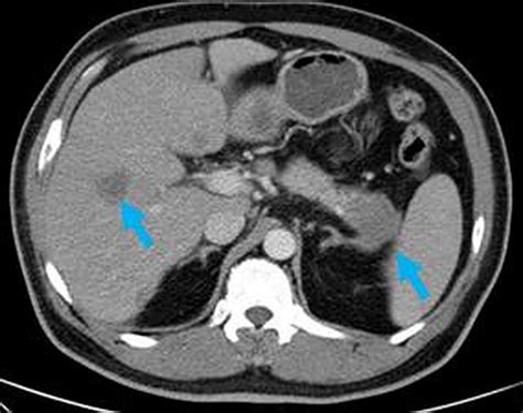 Rare Case Of Pancreatic Adenocarcinoma With Spermatic Cord And Testicular Metastasis Bmj Case