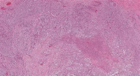 Thyroid Cancer Archives Ottawa Atlas Of Pathology