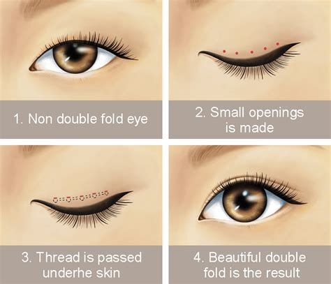 5 Differences Between Incisional And Non Incisional Double Eyelid