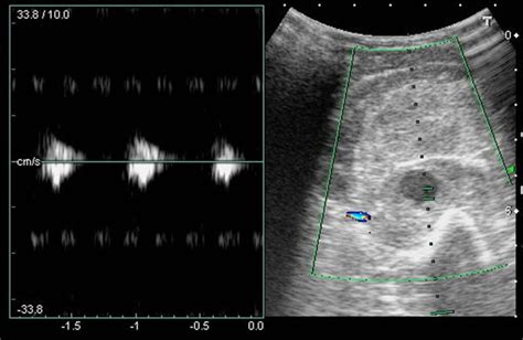 Early Detection Of Blunt Traumatic Brachial Artery Pseudoaneurysm By