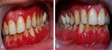 Diffuse Intense Gingival Erythema With Slight Edema And With Small