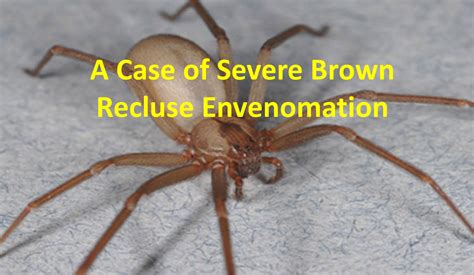 A Case of Severe Brown Recluse Envenomation - emdocs