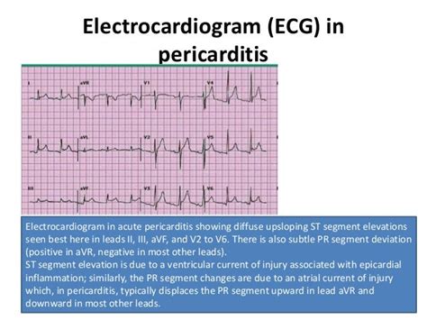 Acute Pericarditis ECG Changes