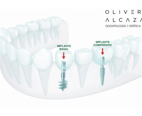 Implantes Compresivo O Basal Mejorando Nuestra Calidad De Vida