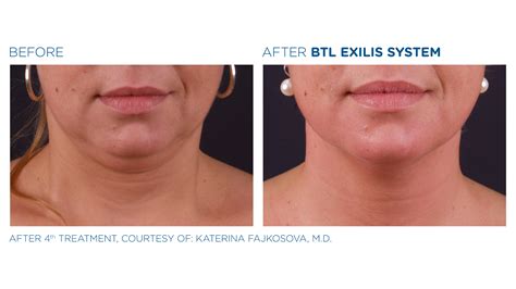 Skin Tightening Treatments In Columbus Ohio With Exilis Ultra