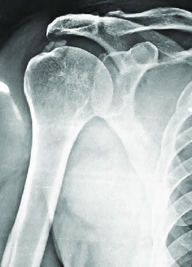 X Ray Findings Radiograph Shows Calcific Tendinitis Arrow In