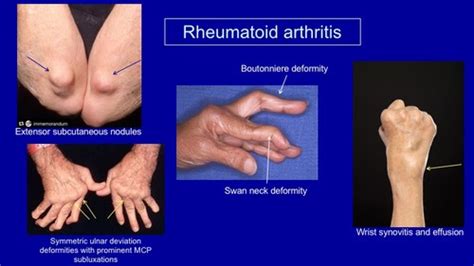 Ortho Exam 3 Flashcards Quizlet