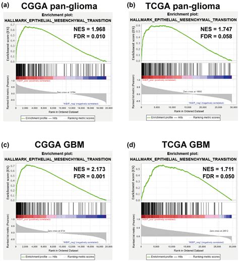 Ikbip Is A Novel Emt Related Biomarker And Predicts Poor Survival In Glioma