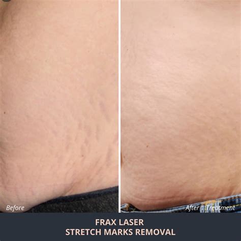 Stretch Marks Removal Help Striae Treatments Novuskin