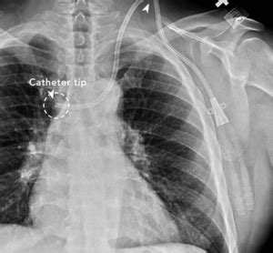 Hemodialysis Catheter Complications (And What To Do About Them) - Renal ...