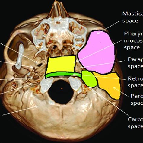 Axial Ct Bone Window Of Skull Base From Inferior To Superior Aspect