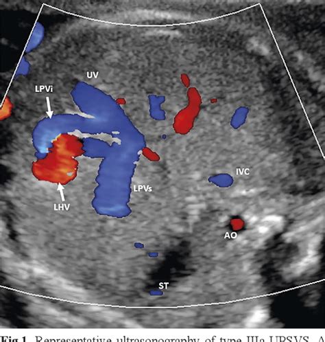 Figure 1 From Ultrasonographic Characteristics And Outcome Of Type III