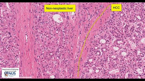 Liver Hepatocellular Carcinoma Microscopy Talking Slide Youtube