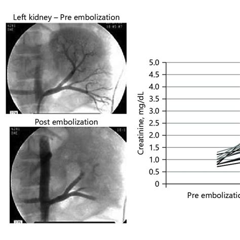 Left Arteriograms Of Renal Flow Pre Embolization In Right And Left Download Scientific