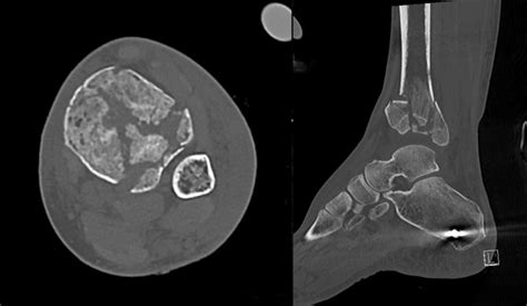 [figure Axial And Sagittal Ct Slices ] Statpearls Ncbi Bookshelf