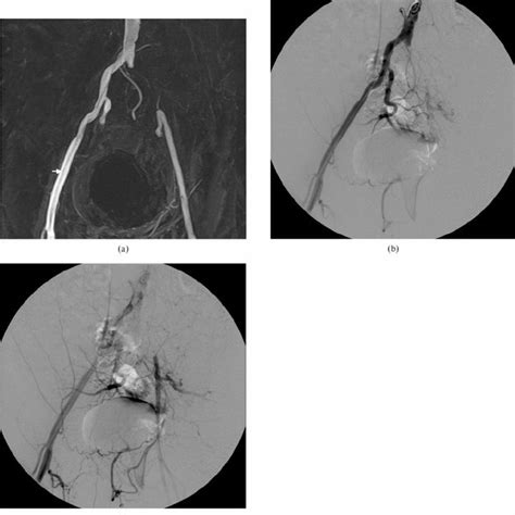 Classification Of Stenoses Results Of Intra Arterial Mr Angiography