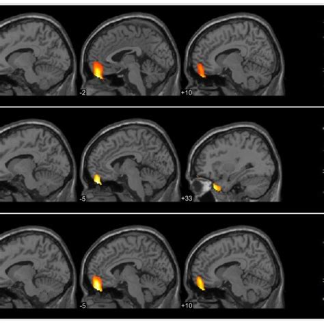 A Cluster Of Decreased Grey Matter Volume In The Patient Group N 30