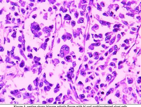 Figure 1 From Malignant Phyllodes Tumor With Necrosis A Rare Case