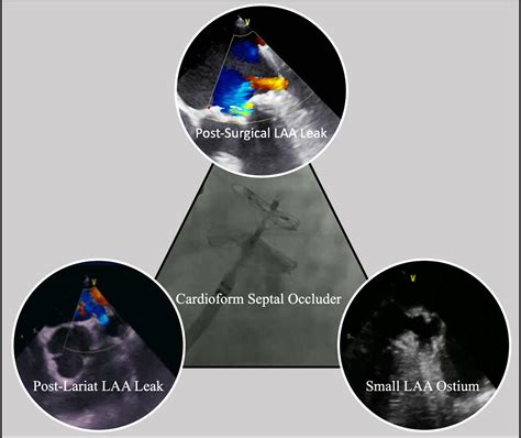 Use Of A Novel Septal Occluder Device For Left Atrial Appendage Closure