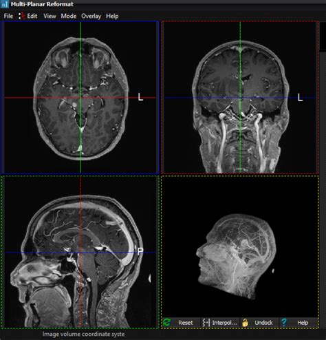 Maximum Intensity Projection Mip