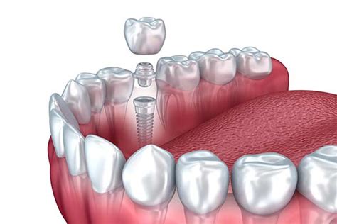 Restorative Dentistry In Easton Pa Fabey Dental