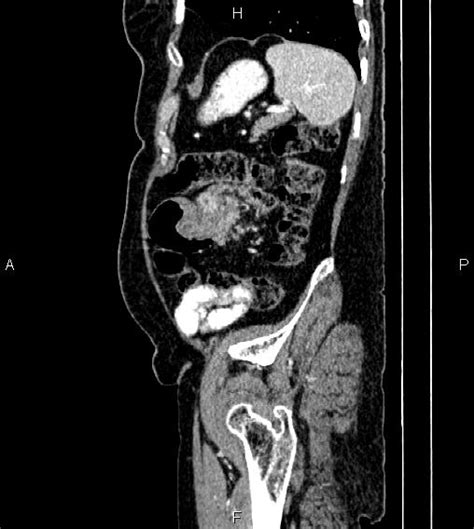 Colocolic Intussusception Due To Tumoral Infiltration Image