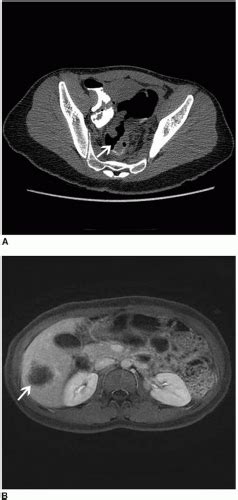 Surgical Management of Stage IV Colorectal Cancer | Oncohema Key