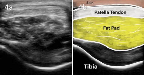 Patellar Tendinitis Physiotherapy Hot Sex Picture