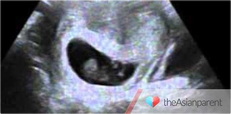 Vanishing Twin Syndrome Symptoms Causes And Diagnosis