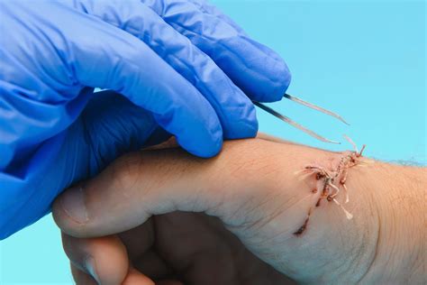 Comment Retirer Ses Points De Suture Acapros Fr