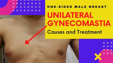 😱 Unilateral Gynecomastia एकतरफा Gyno को कैसे करें कम् One Sided