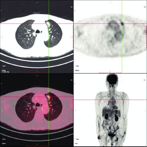 Fluorodeoxyglucose 18F FDG Position Emission Tomography PET CT Was