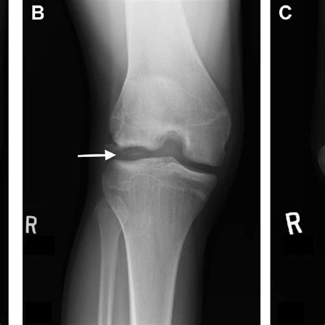 Anteroposterior A Rosenberg B And Lateral C Radiographs Showing Download Scientific