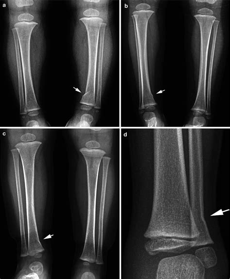 Normal Pediatric Ankle Xray