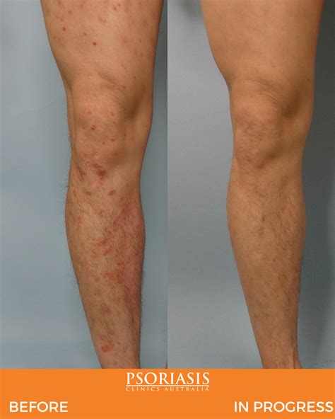 Psoriasis Legs Treatment