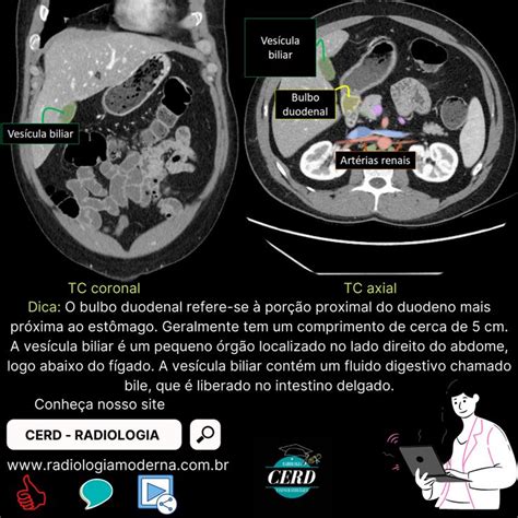 TC Vesícula biliar Bulbo duodenal e Artérias renais Radiología