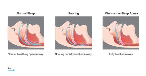 Snoring Sleep Apnea Cpap Alternative Magnolia Dental Spa