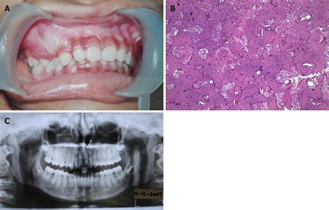 Fibrous Dysplasia Of Maxilla