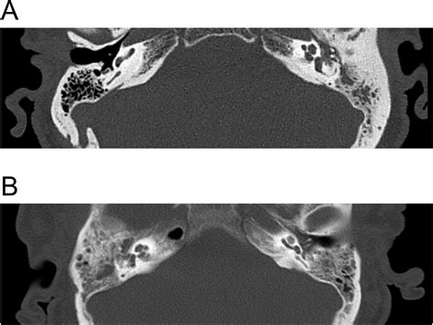 Differences In Mastoid And Middle Ear Cavity Opacification In Ct