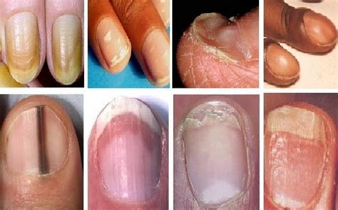 This Is What Your Fingernails Say About Your Health Health And Wellness