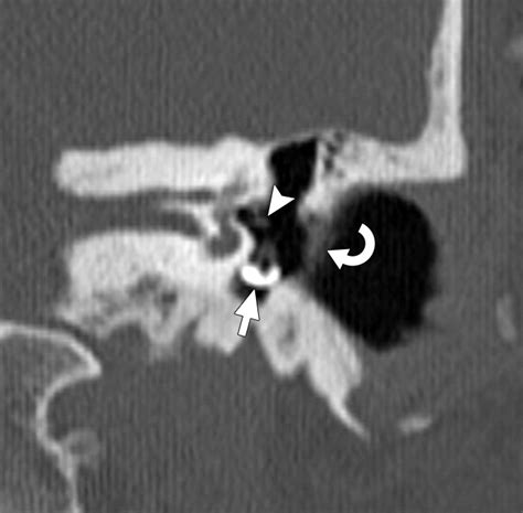 Imaging Review Of The Temporal Bone Part Ii Traumatic Postoperative