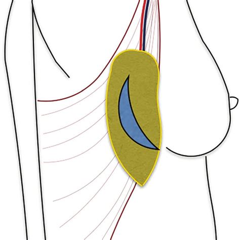 A Tdap Flap With An Oblique Downward Skin Paddle Blue B Extended