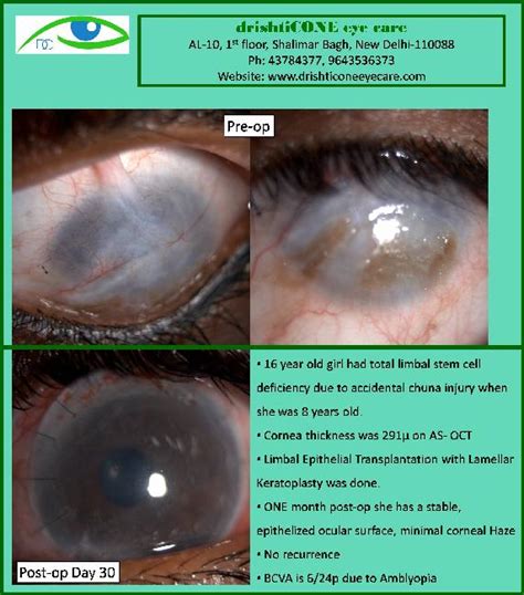 Limbal Stem Cell Deficiency does not benefit ONLY with a Corneal ...