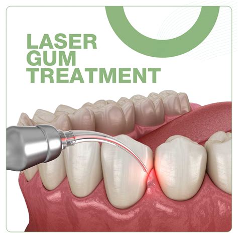 Laser Gum Treatment Cosmetic Dentistry Procare Dental Group