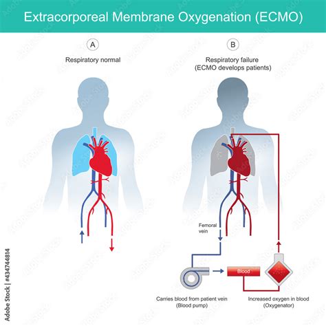 Extracorporeal Membrane Oxygenation Diagram For Explain Rescue