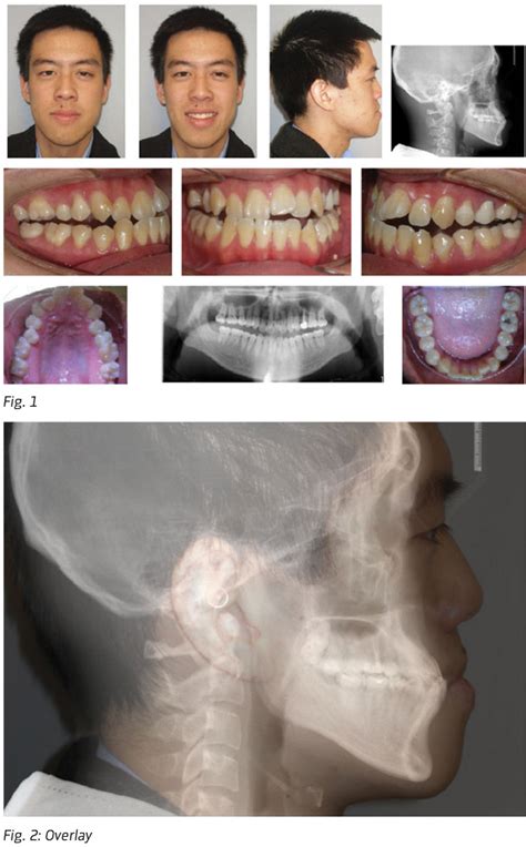 Class Iii Malocclusion Treated Non Surgically With Invisalign Mandibular Fixed Appliances