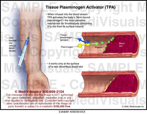 Tissue Plasminogen Activator (TPA) Medical Exhibit Medivisuals